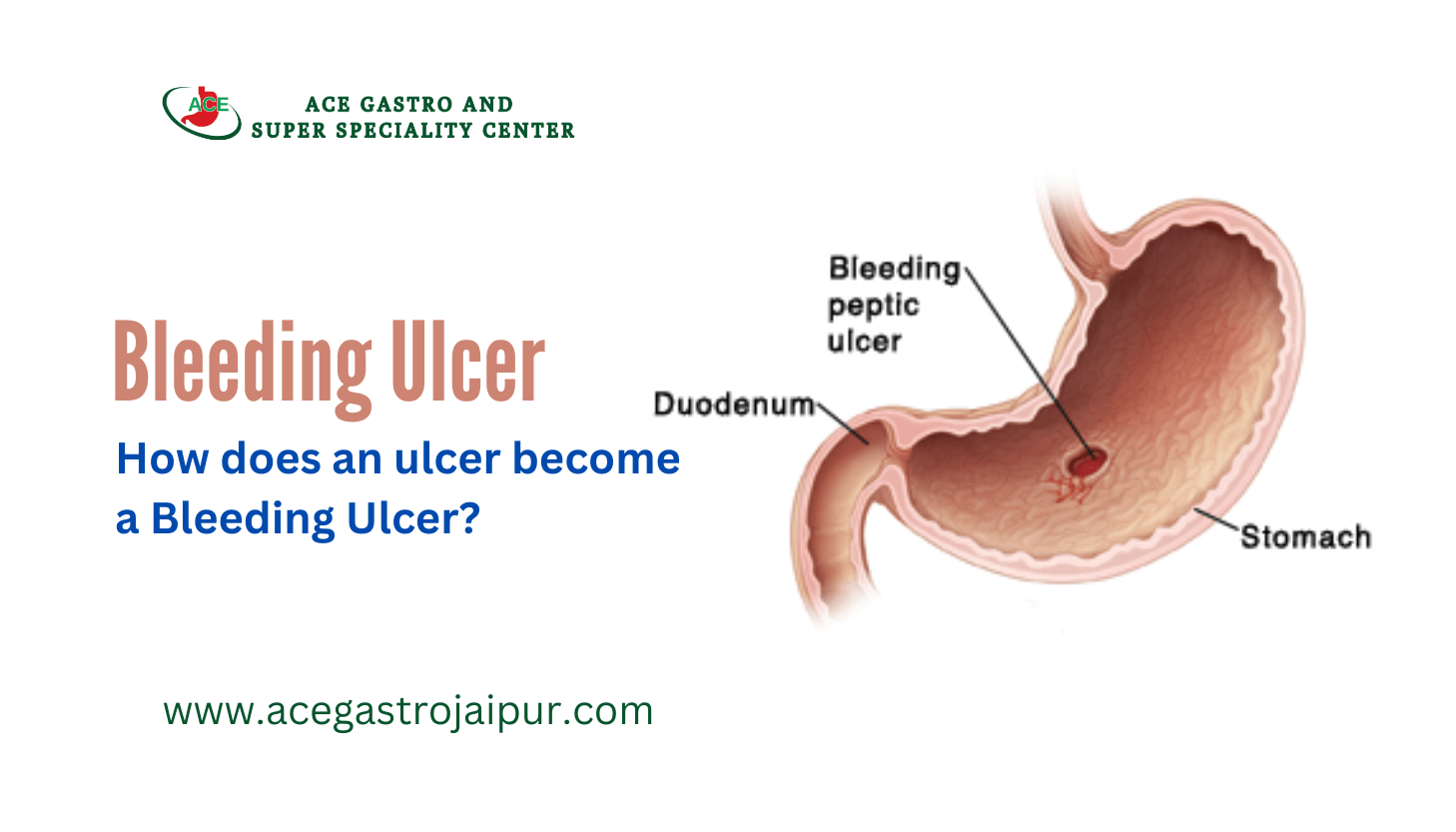 How does an ulcer become a Bleeding Ulcer?