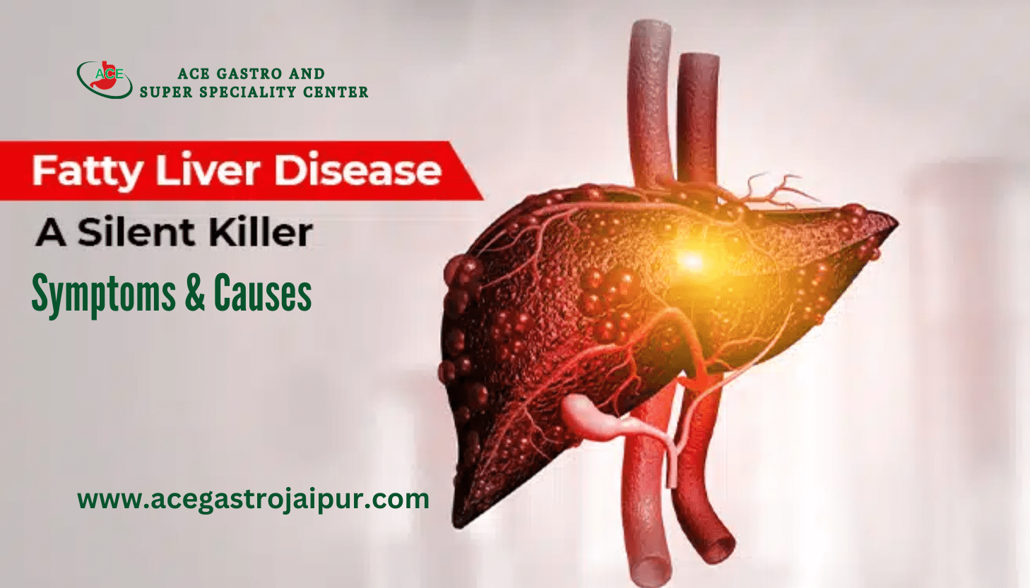 Understanding Fatty Liver: Causes, Symptoms, and Treatment