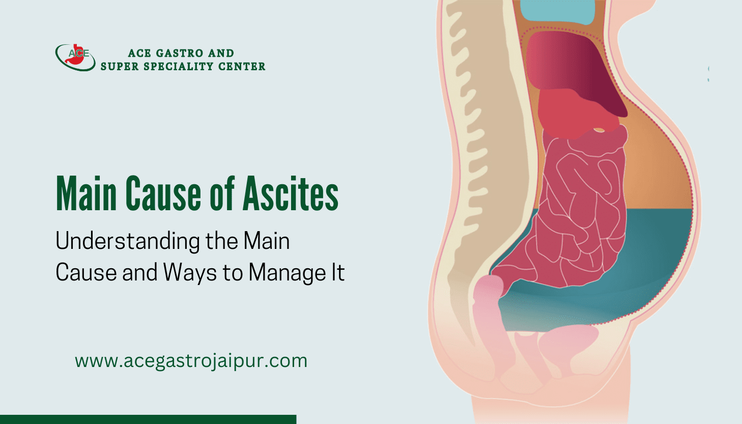 Ascites: Understanding the Main Cause and Ways to Manage It
